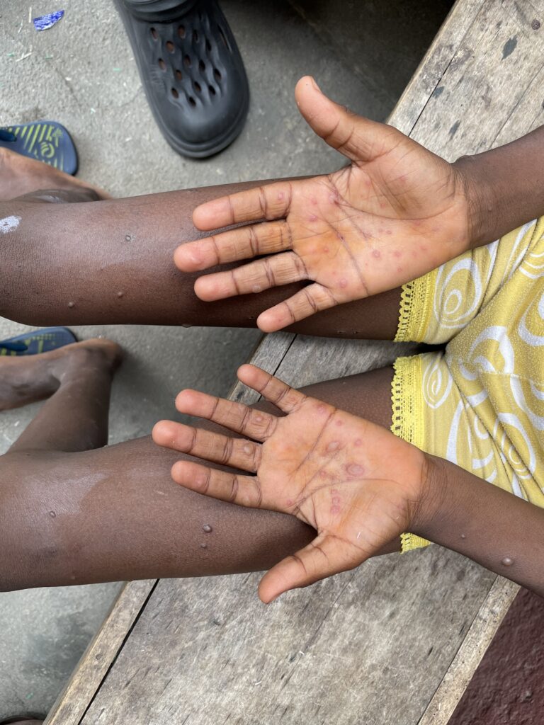 Lagos resident child’s hands and legs with lesions, typical of mpox or chickenpox infection. We see the palms face up and part of the child’s legs.
